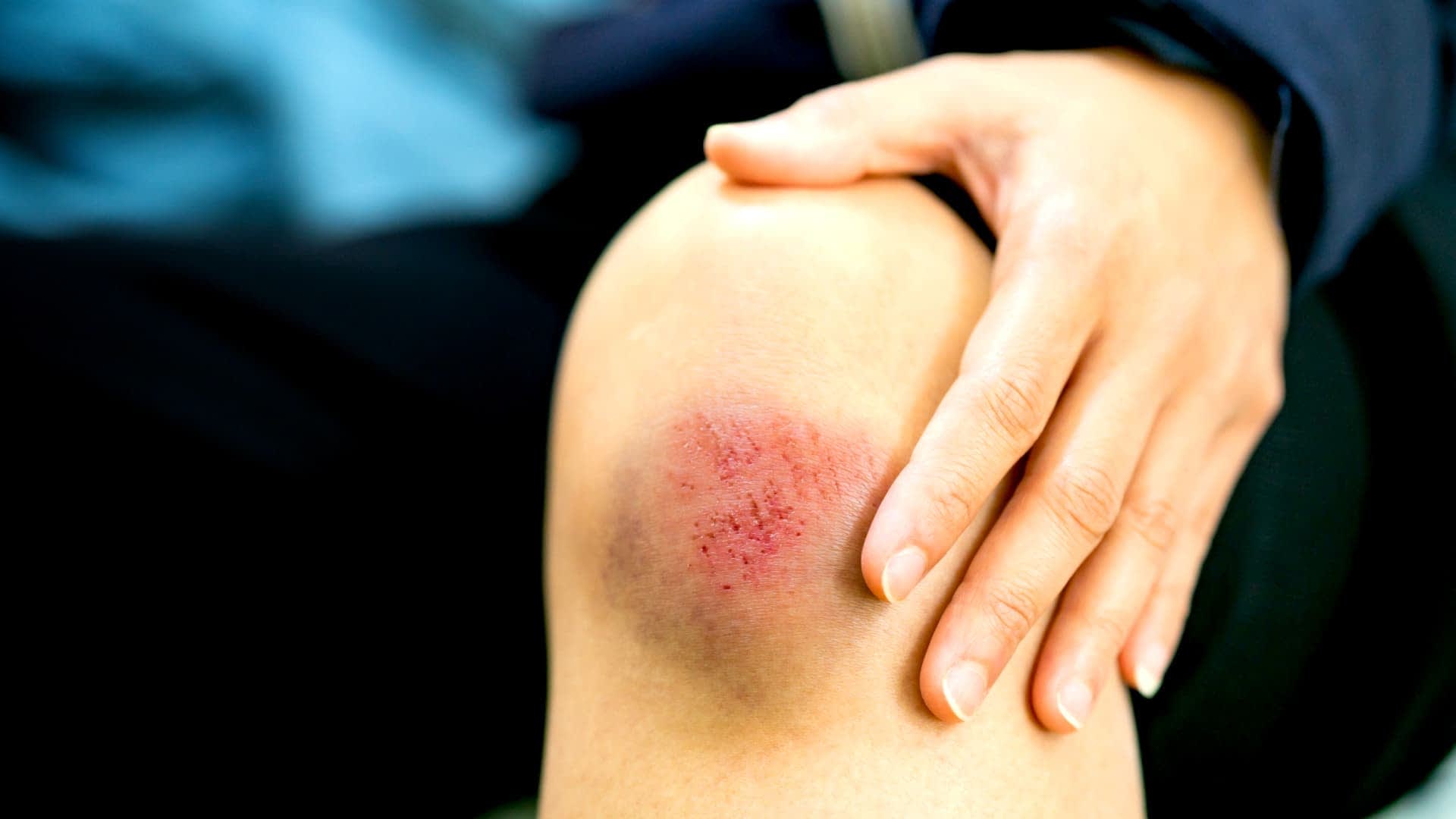Close-up of a person's knee showing a bruise and scrape with a hand resting on it. - Olive Oil Times