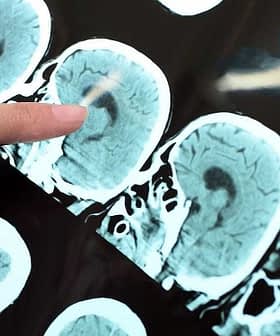 A hand pointing at a series of brain scans displayed on a screen. - Olive Oil Times