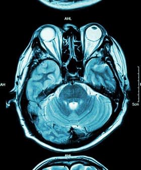 Three axial MRI brain scan images showing different cross-sections of the brain. - Olive Oil Times