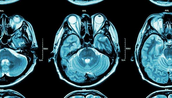 Three axial MRI brain scan images showing different cross-sections of the brain. - Olive Oil Times