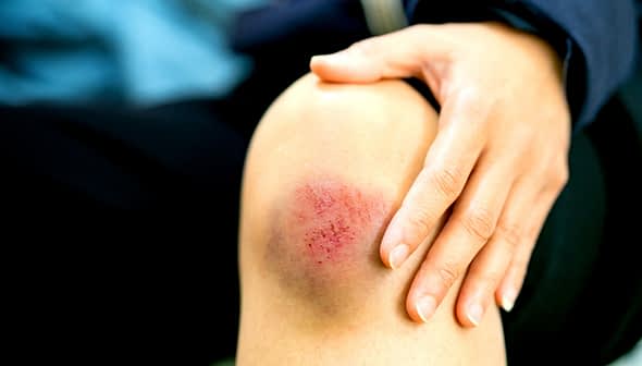 Close-up of a person's knee showing a bruise and scrape with a hand resting on it. - Olive Oil Times