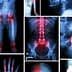 Collage featuring various medical X-ray images of bones and joints in different positions and conditions. - Olive Oil Times