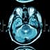 Three axial MRI brain scan images showing different cross-sections of the brain. - Olive Oil Times
