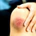 Close-up of a person's knee showing a bruise and scrape with a hand resting on it. - Olive Oil Times