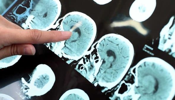 A hand pointing at a series of brain scans displayed on a screen. - Olive Oil Times
