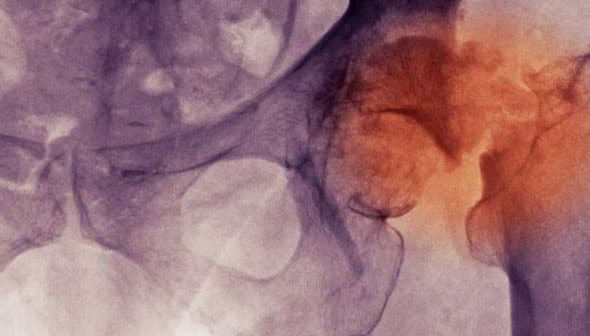 Medical imaging showing the hip joint with highlighted areas indicating potential issues. - Olive Oil Times
