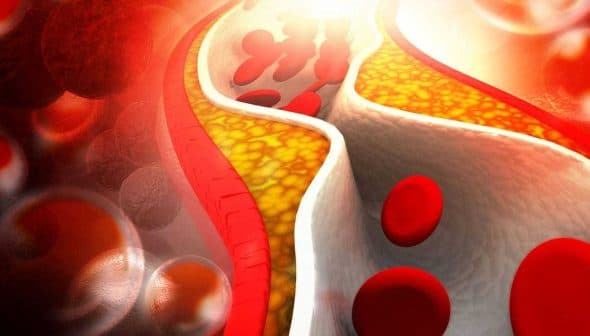 Illustration depicting blood vessels with red blood cells and cholesterol buildup inside. - Olive Oil Times