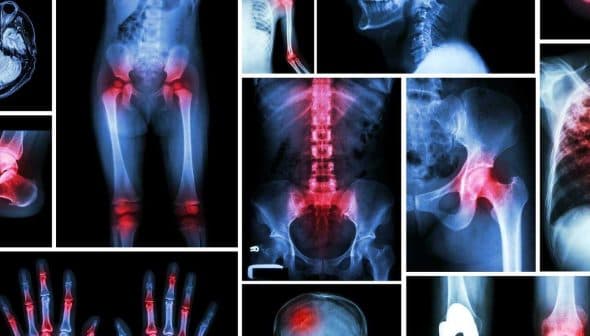 Collage featuring various medical X-ray images of bones and joints in different positions and conditions. - Olive Oil Times