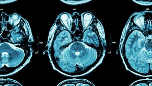 Three axial MRI brain scan images showing different cross-sections of the brain. - Olive Oil Times