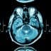 Three axial MRI brain scan images showing different cross-sections of the brain. - Olive Oil Times